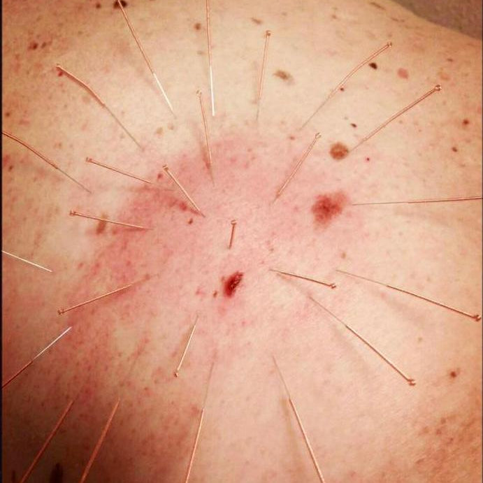 Acupuntura para el Herpes Zóster (Culebrilla) y Neuralgia Postherpética