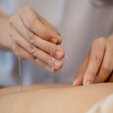 Acupuntura para Tendinitis, puntos gatillo y esguinces (60 min)