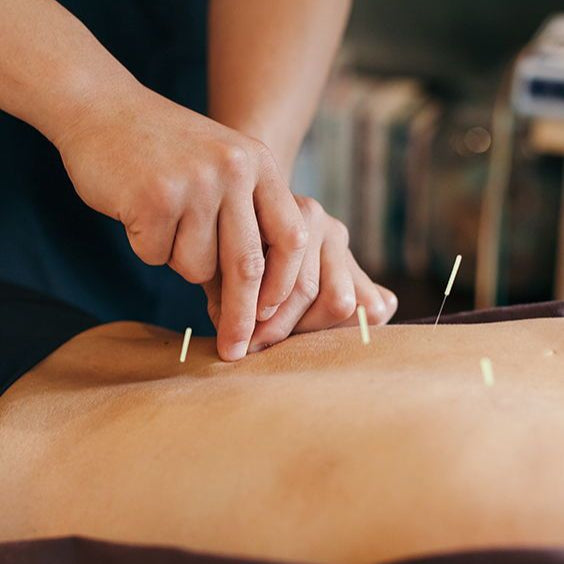 Acupuntura para Náuseas y Vómitos (Postoperatorios o Inducidos por Quimioterapia)