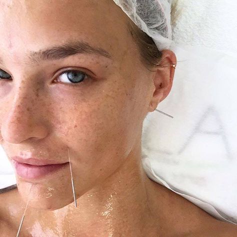 Acupuntura para Migrañas y Cefaleas Tensionales