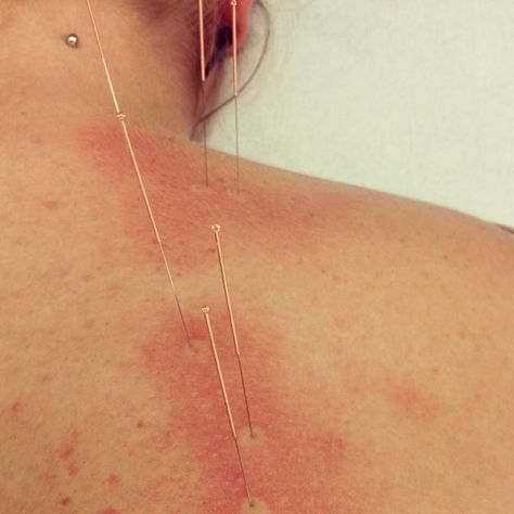 Acupuntura para Fatiga Crónica y Fibromialgia