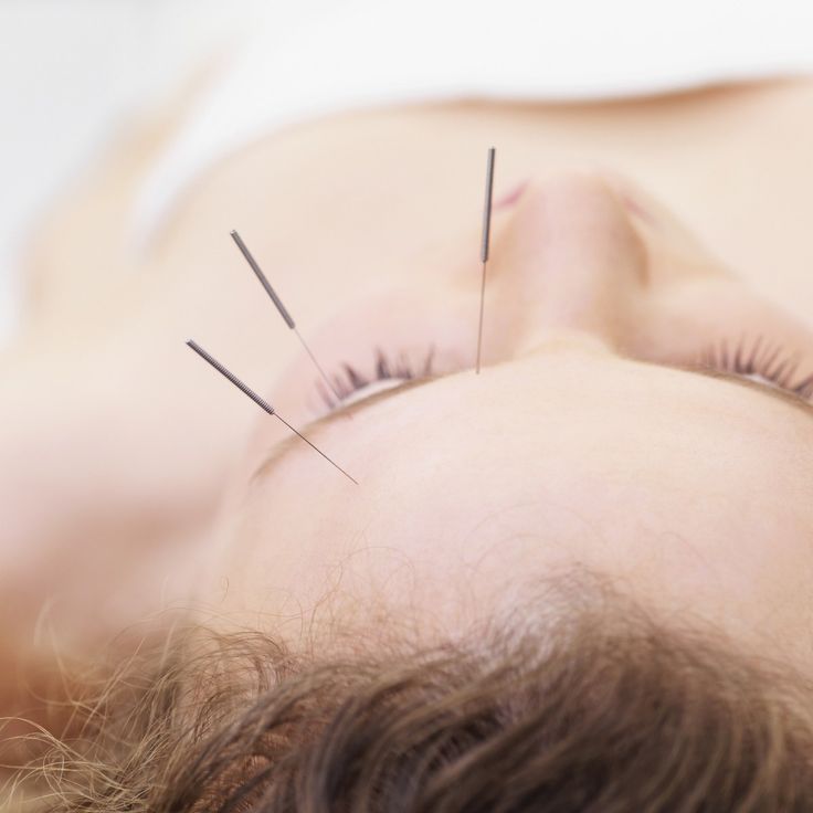 Acupuntura para la Parálisis Facial y la Recuperación Post-Accidente Cerebrovascular