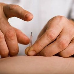 Acupuntura para el Dolor Crónico