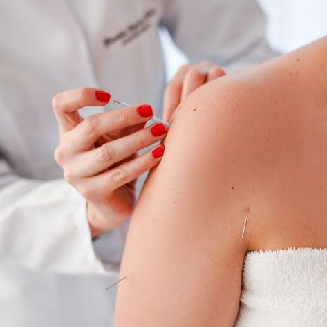 Acupuntura para la Tendinitis y Lesiones Musculoesqueléticas (Síndrome túnel carpiano)