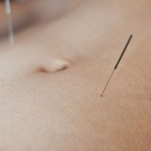 Acupuntura para el Dolor Menstrual y el Síndrome Premenstrual (SPM)